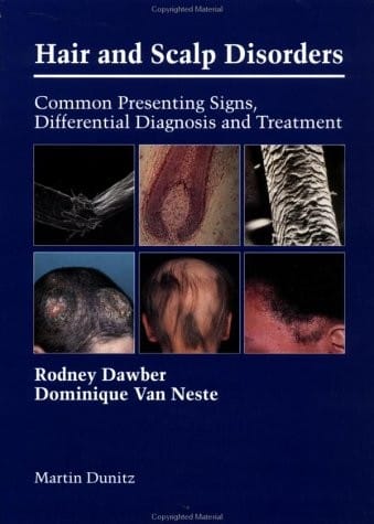 Hair and Scalp Disorders: Common Presenting Signs, Differential Diagnosis and Treatment