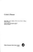 Crohn's disease.