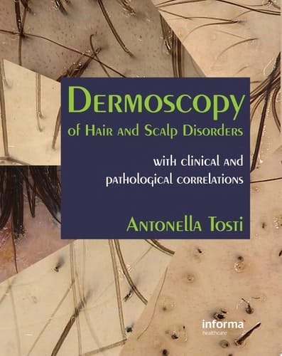 Dermoscopy of Hair and Scalp Disorders: With Clinical and Pathological Correlations