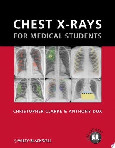 Chest X-rays for Medical Students