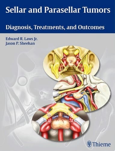 Sellar and Parasellar Tumors Diagnosis, Treatments, and Outcomes