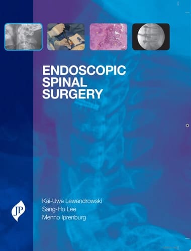 Endoscopic Spinal Surgery