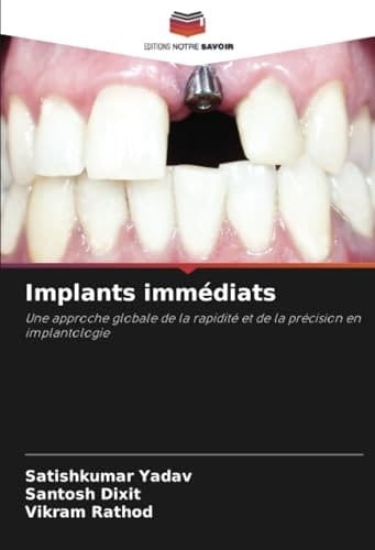 Implants immédiats: Une approche globale de la rapidité et de la précision en implantologie (French Edition)