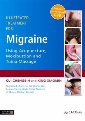 Illustrated treatment for migraine using acupuncture, moxibustion, and tuina massage