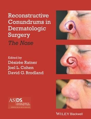 Reconstructive Conundrums In Dermatologic Surgery The Nose