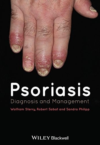 Psoriasis: diagnosis and management