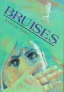 Bruises