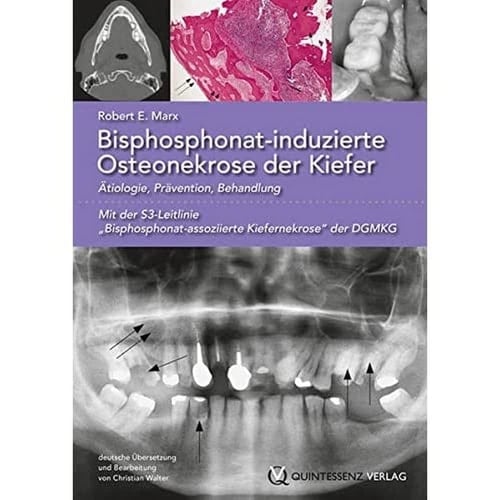 Bisphosphonat-induzierte Osteonekrose der Kiefer Ätiologie, Prävention, Behandlung ; [mit der S3-Richtlinie "Bisphosphonat-assoziierte Kiefernekrose" der DGMKG]
