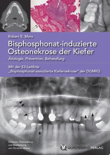 Bisphosphonat-induzierte Osteonekrose der Kiefer Ätiologie, Prävention, Behandlung