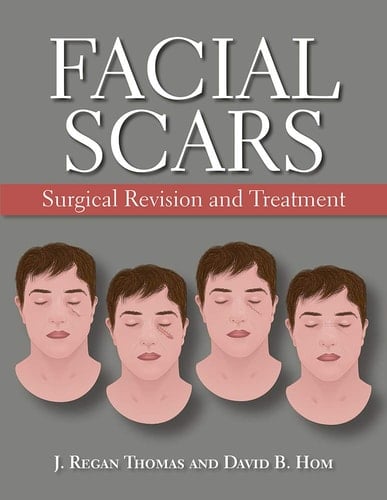 Facial Scars Surgical Revision and Treatment