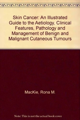 Skin Cancer An Illustrated Guide to the Aetiology, Clinical Features, Pathology and Management of Benign and Malignant Cutaneous Tumours