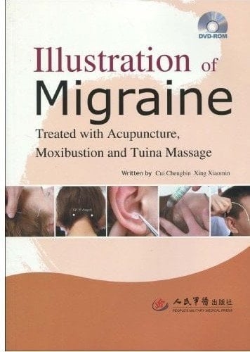 Illustration of Migraine Treated with Acupuncture, Moxibustion and Tuina Massage
