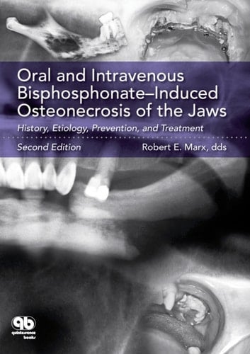 Oral and Intravenous Bisphosphonate–Induced Osteonecrosis of the Jaws: History, Etiology, Prevention, and Treatment, Second Edition