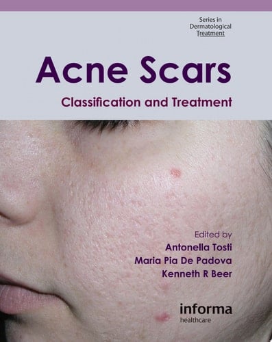 Acne Scars Classification and Treatment
