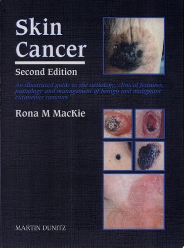 Skin Cancer, Second Edition