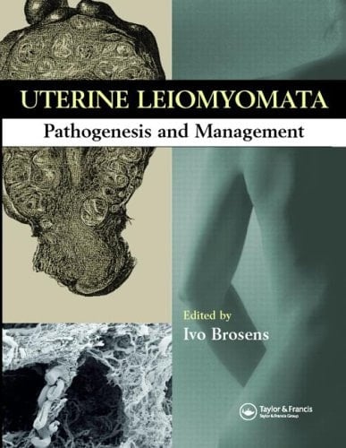 Uterine Leiomyomas Pathogenesis and Management