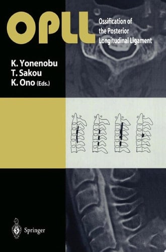 OPLL Ossification of the Posterior Longitudinal Ligament