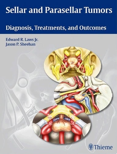 Sellar and Parasellar Tumors Diagnosis, Treatments, and Outcomes