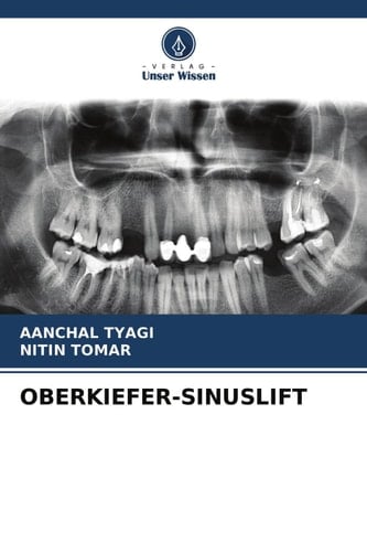 OBERKIEFER-SINUSLIFT (German Edition)