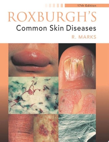 Roxburgh's Common Skin Diseases, 17Ed