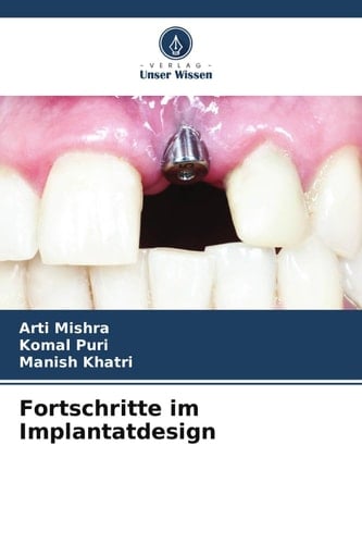 Fortschritte im Implantatdesign (German Edition)