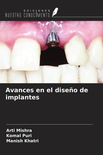 Avances en el diseño de implantes (Spanish Edition)