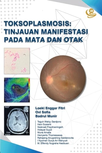 Toksoplasmosis Tinjauan Manifestasi pada Mata dan Otak