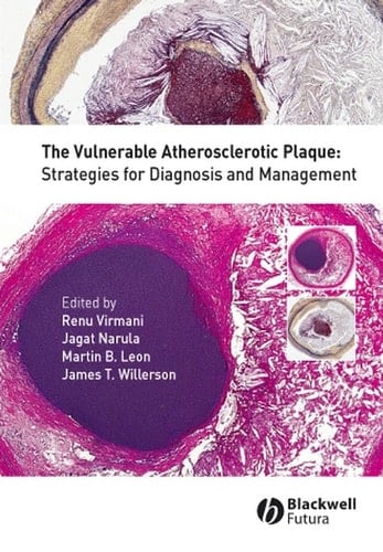 The Vulnerable Atherosclerotic Plaque Strategies for Diagnosis and Management