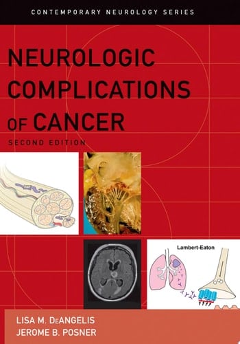 Neurologic Complications of Cancer (Contemporary Neurology Series Book 73)