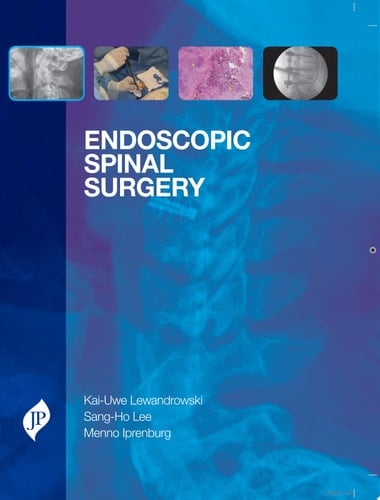 Endoscopic Spinal Surgery