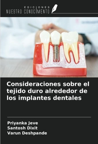 Consideraciones sobre el tejido duro alrededor de los implantes dentales (Spanish Edition)