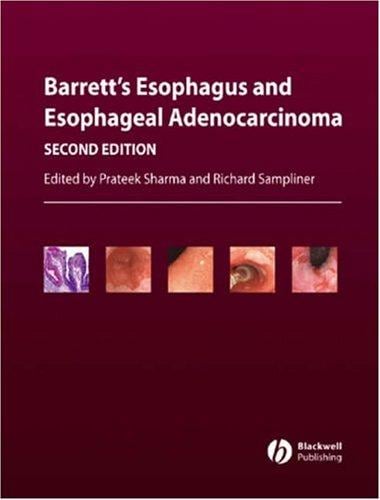 Barrett's esophagus and esophageal adenocarcinoma