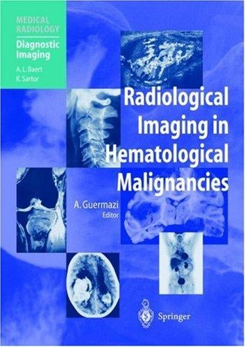 Radiological imaging in hematological malignancies