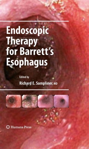 Endoscopic therapy for Barrett's esophagus