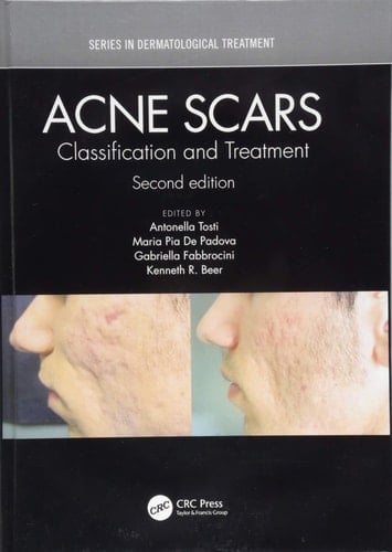 Acne Scars Classification and Treatment, Second Edition
